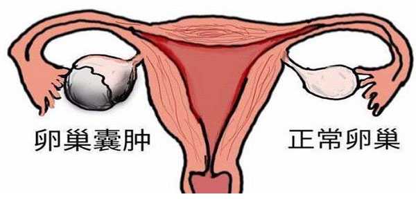厦门借卵生子得多少钱 卵巢囊肿做试管婴儿的成功率比正常略低5-10％